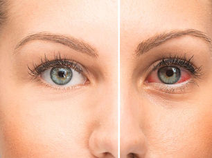 Best Ayurvedic Treatment Centres For Dry Eyes Sanjeevan Netralaya