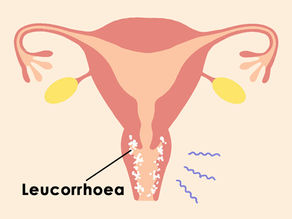 Leucorrhoea Types Causes Symptoms Diagnosis & Treatment