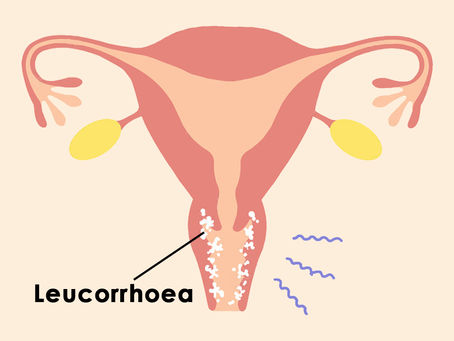 Leucorrhoea Types Causes Symptoms Diagnosis & Treatment