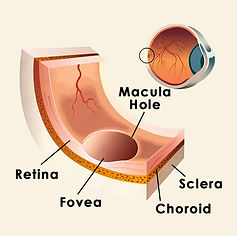 macula-hole (1).jpg