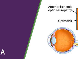 Ischematic Optic Neuropathy (ION)