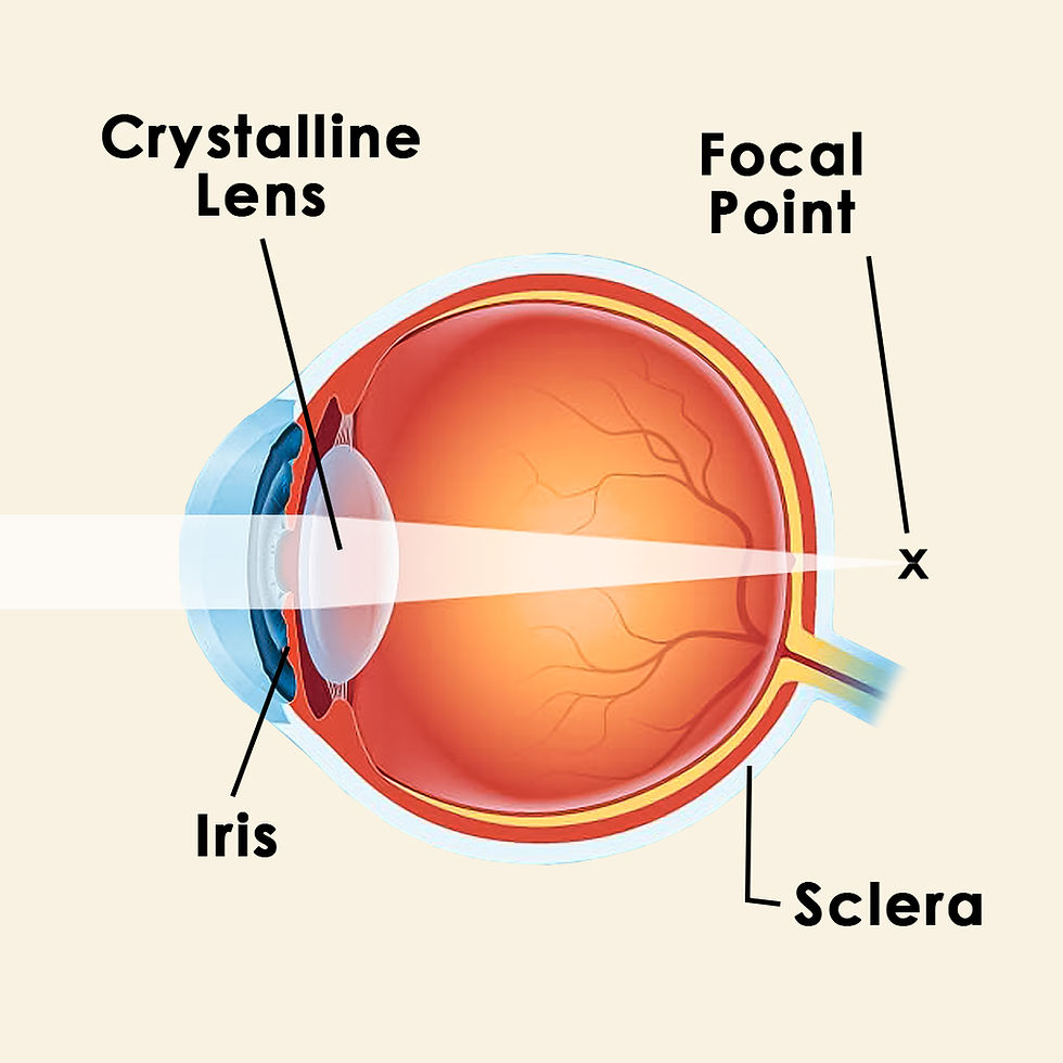 Presbyopia Causes Symptoms and Remedies