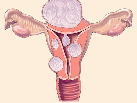 Metrorrhagia Types Causes Symptoms Diagnosis & Treatment