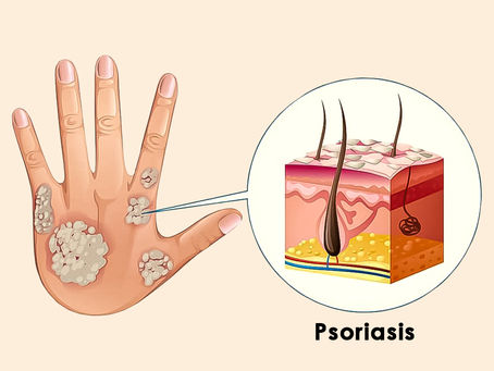 Psoriasis Types Causes Symptoms & Treatment