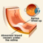 Vitreous Degeneration Causes Symptoms Treatment