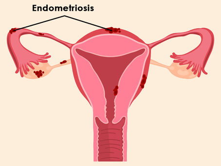 Endometriosis Types Causes Symptoms Diagnosis & Treatment