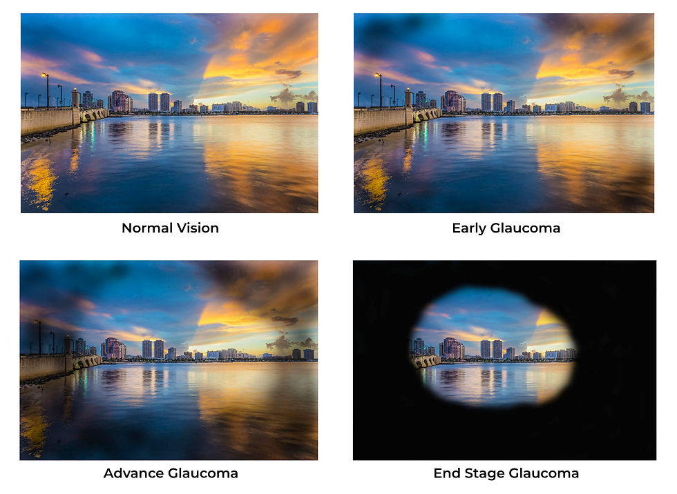 Vision-of-glaucoma-patient.jpg