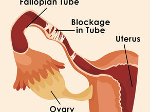 Tubal Blockage Types Causes Symptoms Diagnosis & Treatment