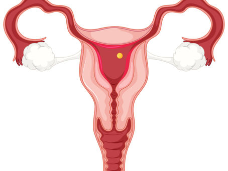 Vaginal Polyps Types Causes Symptoms Diagnosis & Treatment