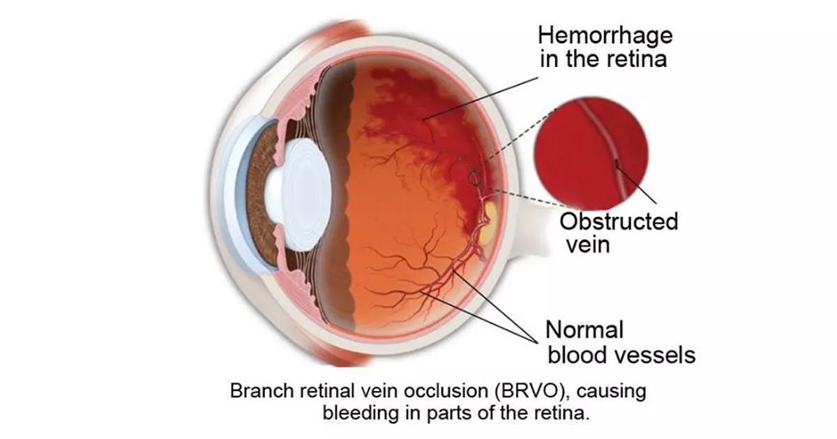 Branch-Retinal-Vein-Occlusion-sanjeevan-netralaya