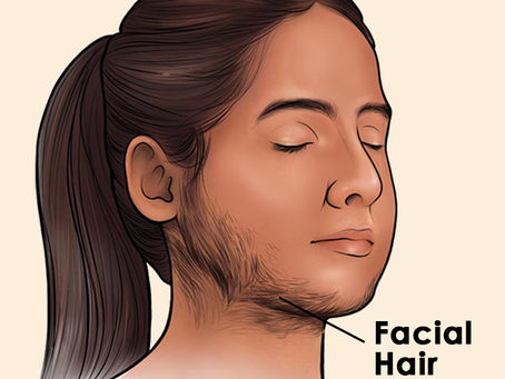 Hirsutism Types Causes Symptoms Diagnosis & Treatment