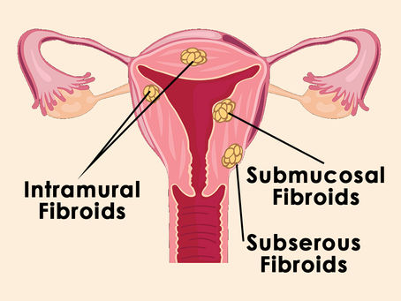 Fibroids Types, Causes, Symptoms, Diagnosis & Treatment