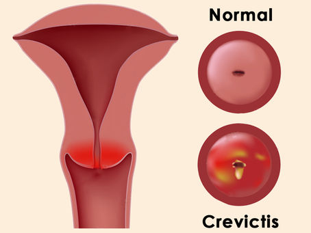 Cervicitis Types Causes Symptoms Diagnosis & Treatment