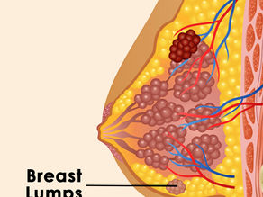 Breast lumps Types Causes Symptoms Diagnosis & Treatment