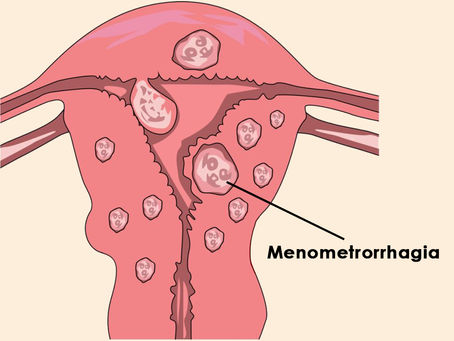 Menometrorrhagia Types Causes Symptoms Diagnosis & Treatment