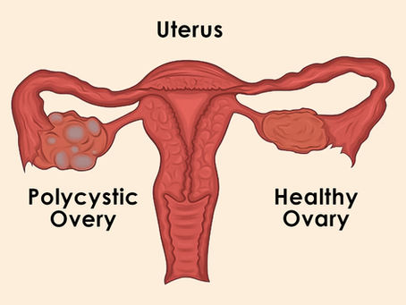 Polycystic Ovary Syndrome (PCOS) Causes, Symptoms & Treatment