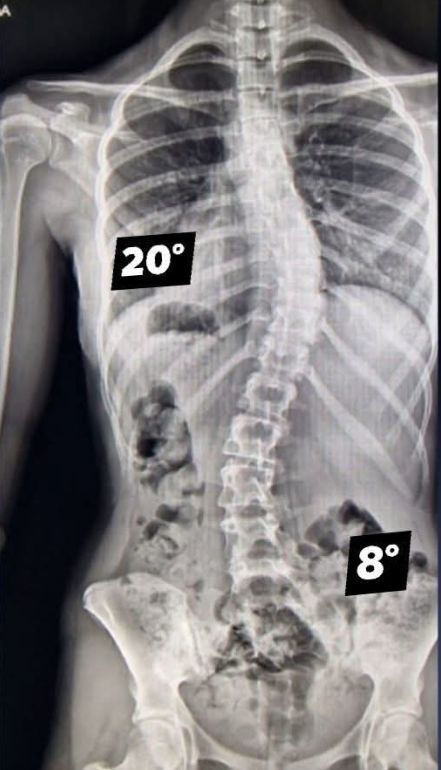 scoliosis x-ray after treatment