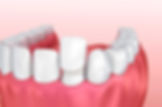 3-Benefits-of-Custom-Porcelain-Veneers.j