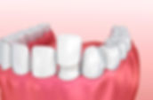 3-Benefits-of-Custom-Porcelain-Veneers.j