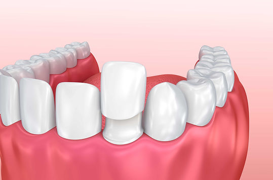 3-Benefits-of-Custom-Porcelain-Veneers.j