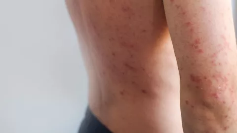 Jalisco acumula 2 mil 662 casos de sarampión en 2026