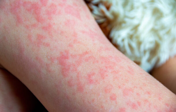 Suman 754 casos de sarampión en Jalisco