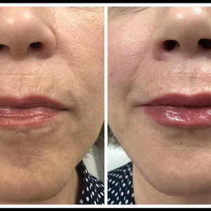 Lip Enhancement Results