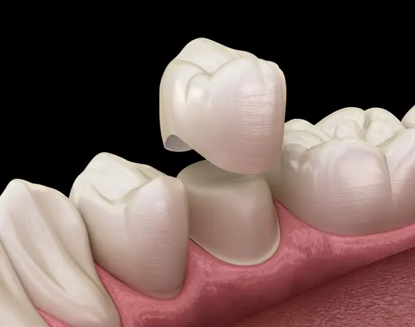 Dental-Crown-on-Molar (1).webp
