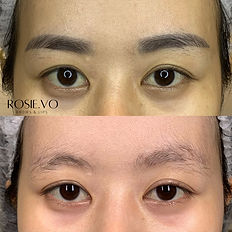 Xoá xăm Laser Pico