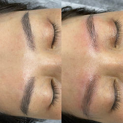 Xoá xăm Laser Pico