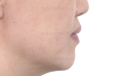 부산치아교정잘하는곳