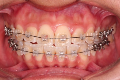 부산연산역치아교정