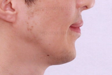 부산구순구개열교정