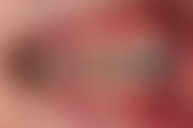 부산덧니교정