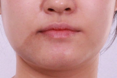 부산치아교정잘하는곳