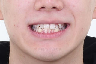 부산덧니교정