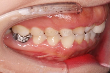 부산구순구개열