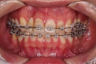 연산동치아교정