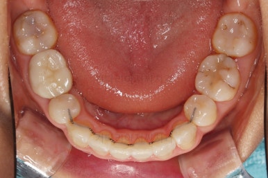 부산인비절라인