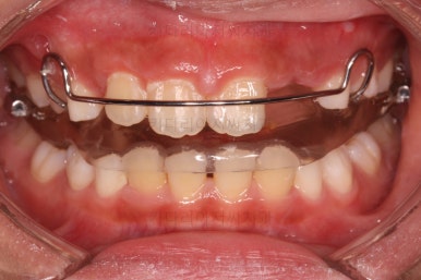 부산어린이돌출입교정