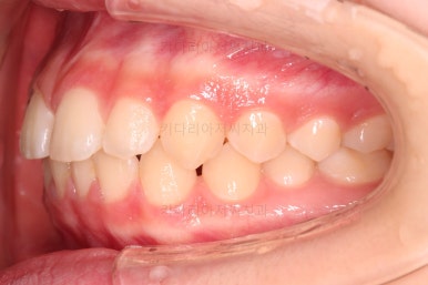 부산앞니벌어짐교정