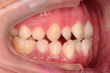 부산긴얼굴긴턱교정