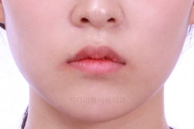 부산클리피씨교정