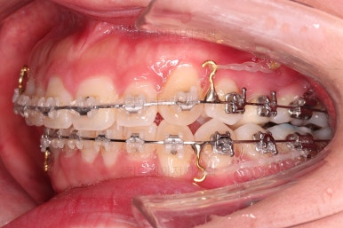 부산비대칭교정