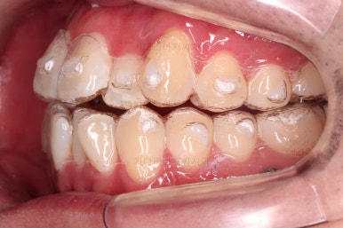 부산인비절라인