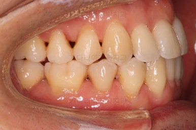 부산비수술교정