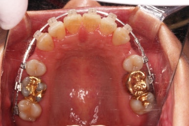 동래임플란트교정