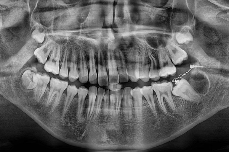 부산연산동사랑니발치