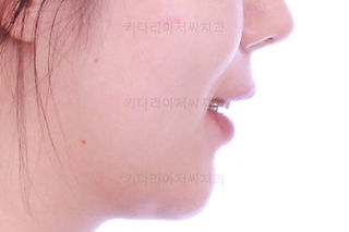 부산부분치아교정 