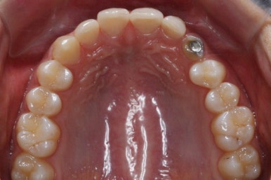 부산매복치아교정